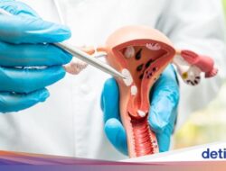 Viral Ramuan ‘Detoks Rahim’ untuk Cegah Kista, Emang Ngaruh? Ini Kata Obgyn