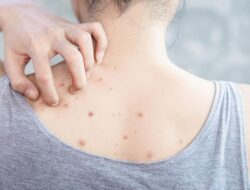 Jerawat Punggung Tak Kunjung Hilang, Coba 8 Tips Mengatasinya