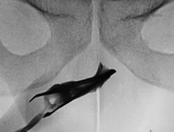 Ngilu! Momen Dokter Temukan Pinset ‘Nyangkut’ di Mr P Selama 4 Tahun